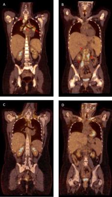 Case Report: Hemophagocytic Lymphohistiocytosis and Non-Tuberculous Mycobacteriosis Caused by a Novel GATA2 Variant